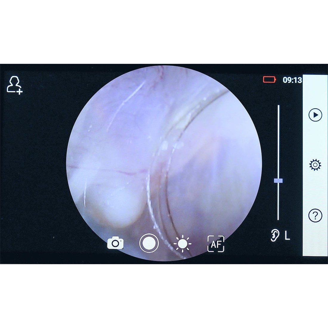 Dermatoscope Connecté : Caméra Médicale RCS-100 Riester